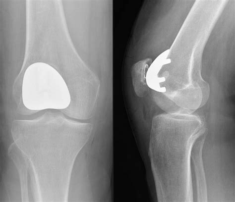 bronze kneecap|knee cap replacement surgery.